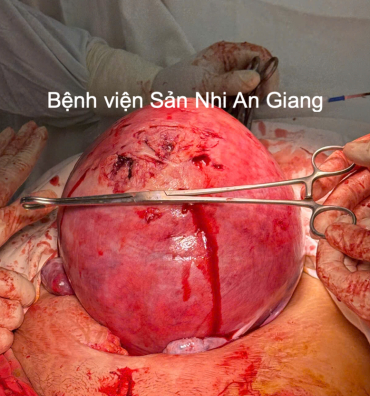 benh vien san   nhi an giang phau thuat thanh cong khoi u xo tu cung khong lo nang 4kg