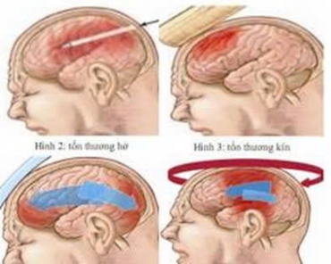 chan thuong so nao  trieu chung va cac dieu can luu y