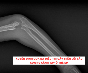 xuyen dinh qua da dieu tri gay tren loi cau xuong canh tay o tre em
