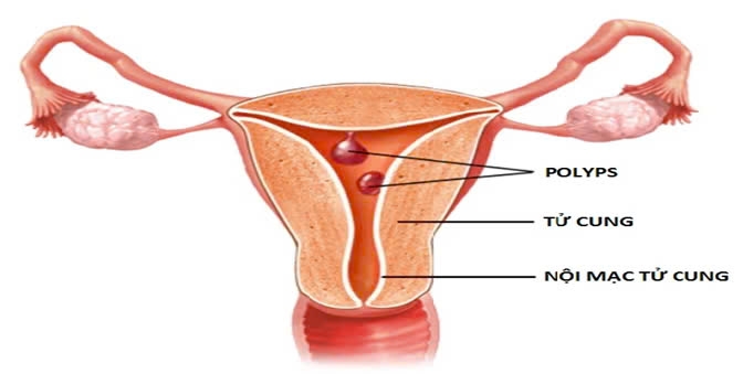 Hình ảnh polyp tử cung.